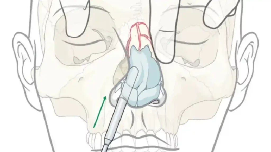 Nasal-Bone-Fractures