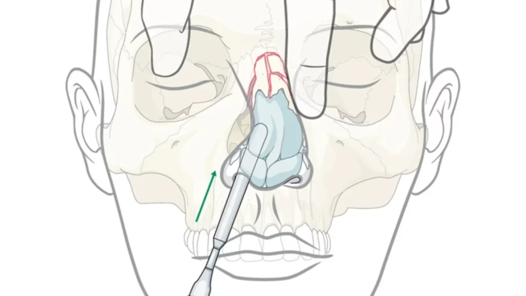 Nasal Bone Fractures